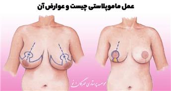 عمل ماموپلاستی چیست و چه عوارضی دارد؟